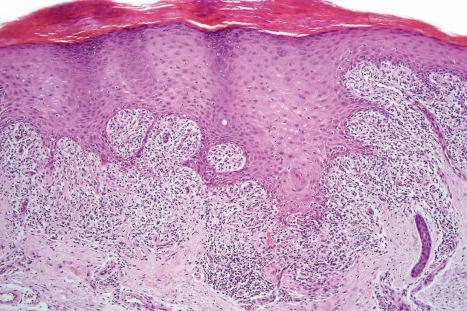 Fig. 14.24, Lichenoid drug reaction: there is hyperkeratosis, hypergranulosis with interface change. Note the superficial bandlike infiltrate. The appearances are indistinguishable from idiopathic lichen planus.