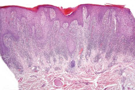 Fig. 14.25, Lichenoid drug reaction: In this example, the changes of hypertrophic lichen planus-like lesions are evident. There is pseudoepitheliomatous hyperplasia and a dense upper dermal lymphohistiocytic infiltrate.