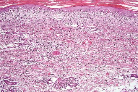 Fig. 14.27, Interface drug reaction: more extensive lesion due to propranolol showing hyperkeratosis, widespread apoptosis, upper dermal edema, and a superficial chronic inflammatory cell infiltrate.