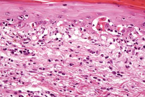 Fig. 14.28, Interface drug reaction: there are numerous apoptotic keratinocytes and severe interface change is evident.