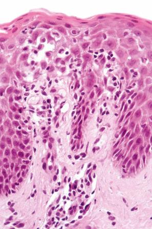 Fig. 14.3, Exanthematous drug reaction: early lesion due to penicillin showing slight interface change, spongiosis, and lymphocytic exocytosis. There is a superficial perivascular lymphocytic infiltrate, and one or two plasma cells are present.