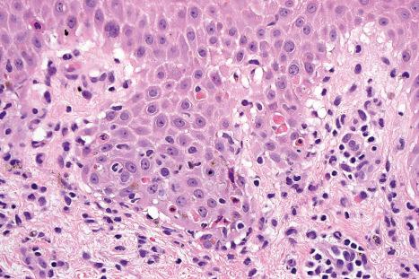 Fig. 14.32, Fixed drug eruption: high-power view showing apoptosis and interface change.