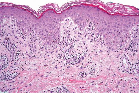 Fig. 14.33, Fixed drug eruption: in this example, the infiltrate has a predominantly perivascular distribution.