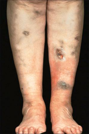 Fig. 14.35, Minocycline pigmentation: these blue-black lesions have developed in a patient with pyoderma gangrenosum.