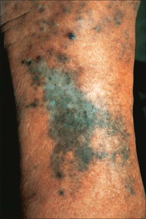 Fig. 14.36, Minocycline pigmentation; typical pigmentation affecting the shin.