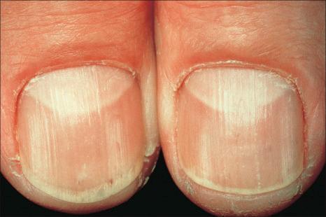 Fig. 14.38, Mepacrine pigmentation: a yellow discoloration is characteristic.