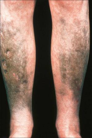 Fig. 14.39, Mepacrine pigmentation: in this patient, the drug resulted in black lesions.