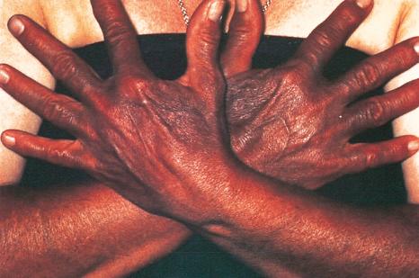 Fig. 14.40, Imipramine pigmentation: note the intense brown pigment of the hands and forearms in comparison with the chest.