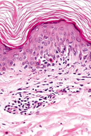 Fig. 14.4, Exanthematous drug reaction: in this example, due to carbamazepine therapy, there is spongiosis, dyskeratosis, and interface change associated with lymphocytic exocytosis.