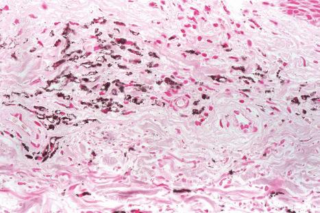 Fig. 14.42, Minocycline pigmentation: the pigment stains positively with Masson-Fontana.