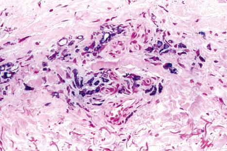 Fig. 14.43, Minocycline pigmentation: the pigment also stains with Prussian blue.