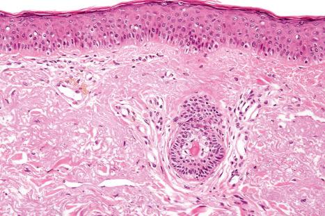 Fig. 14.44, Amiodarone pigmentation: pigmented macrophages are present in a perivascular distribution.