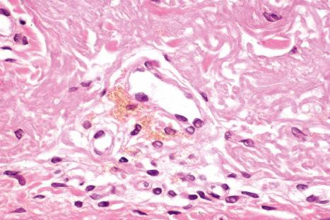 Fig. 14.45, Amiodarone pigmentation: high-power view.