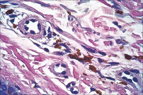 Fig. 14.46, Imipramine pigmentation: typical golden-brown granules. Note that the Prussian blue reaction is negative.