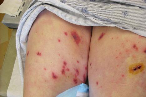 Fig. 14.47, Vasculitic drug reaction: hemorrhagic papules and plaques with central necrosis complicating treatment with propylthiouracil.