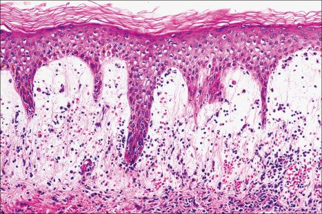 Fig. 14.49, Purpuric drug reaction: there is massive subepidermal edema with red cell extravasation.