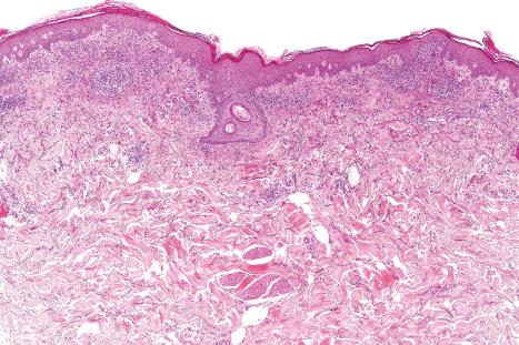 Fig. 14.5, Exanthematous drug reaction: low-power view showing focal parakeratosis, mild acanthosis, and a heavy upper dermal inflammatory cell infiltrate.