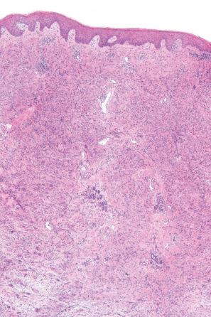 Fig. 14.51, Granulomatous drug reaction: there is a marked infiltrate involving the full thickness of the dermis.