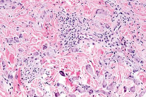 Fig. 14.52, Granulomatous drug reaction: in this example, there is an obvious interstitial distribution reminiscent of granuloma annulare.