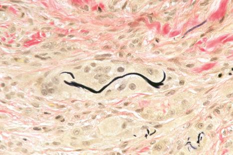 Fig. 14.53, Granulomatous drug reaction: there is extensive elastophagocytosis (elastic van Gieson).