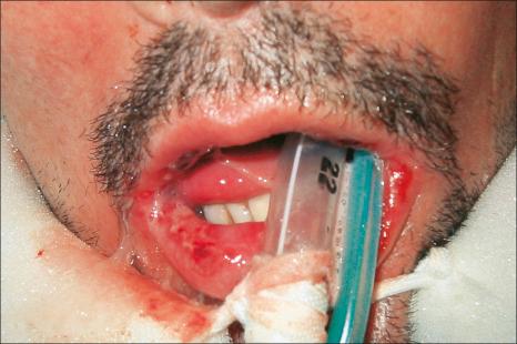 Fig. 14.57, Drug-induced linear IgA disease: oral lesions were also present.