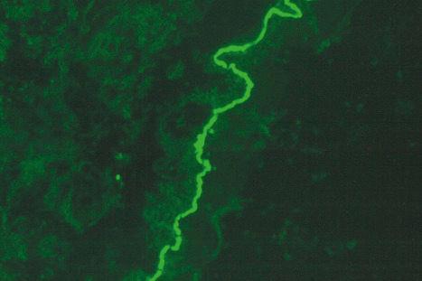 Fig. 14.58, Vancomycin-induced linear IgA disease: immunofluorescence showed strong basement membrane deposition of IgA.