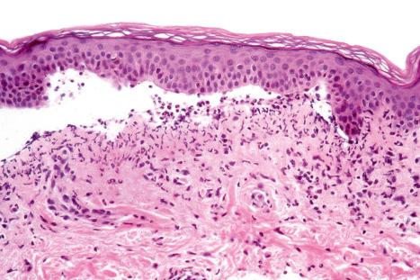 Fig. 14.59, Vancomycin-induced linear IgA disease: this case showed a neutrophil-rich subepidermal blister.