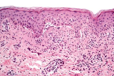 Fig. 14.60, Vancomycin-induced linear IgA disease: the adjacent skin showed neutrophil dermal papillary microabscesses.