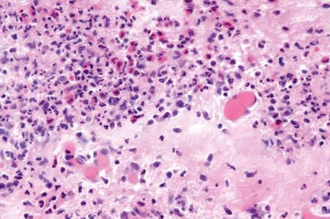 Fig. 14.61, Vancomycin-induced linear IgA disease: conspicuous eosinophils may raise suspicion for bullous pemphigoid if the clinical information is unavailable.