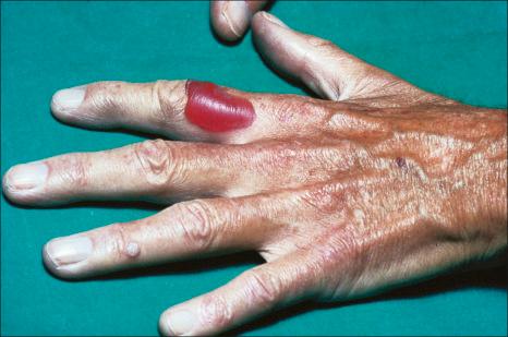 Fig. 14.62, Pseudoporphyria: trauma-induced blisters on the backs of the hands and fingers are characteristic.