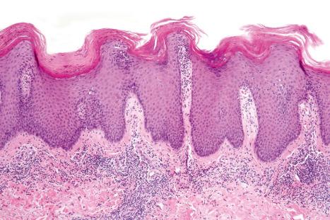 Fig. 14.63, Psoriasiform drug eruption: there is confluent parakeratosis with elongated, broadened, and partially fused rete ridges.