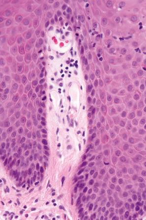 Fig. 14.64, Psoriasiform drug reaction: the capillaries in the dermal papillae are tortuous and dilated.