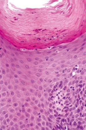 Fig. 14.65, Psoriasiform drug reaction: neutrophils are present in the stratum corneum.