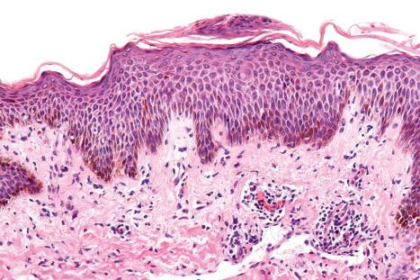 Fig. 14.66, Pityriasiform drug reaction: there is a focal parakeratotic scale associated with acanthosis and spongiosis. A perivascular chronic inflammatory cell infiltrate surrounds the superficial vasculature.