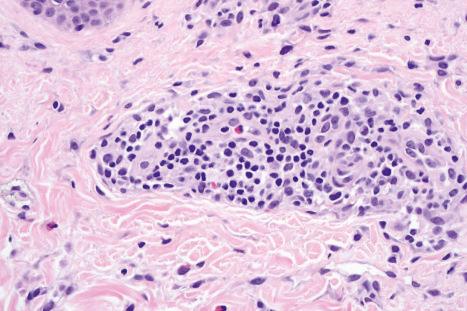 Fig. 14.8, Urticarial drug reaction: high-power view showing a predominately perivascular lymphohistiocytic infiltrate with one or two eosinophils.