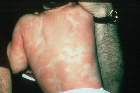 Fig. 14.9, Serum sickness: there is a widespread erythematous and urticarial eruption.