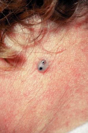 Fig. 34.1, Epidermoid cyst: a typical dome-shaped swelling with two puncta.