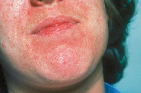 Fig. 34.12, Acne: numerous closed comedones (whiteheads) are present on this patient's cheek and chin.