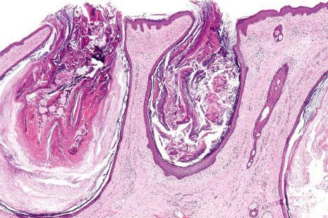 Fig. 34.13, Open comedone: the lesion consists of a cystically dilated hair follicle containing abundant keratin.