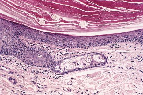 Fig. 34.14, Open comedone: the wall is composed of squamous epithelium. In addition to keratin, there are three pale-staining vellus hairs. Note the atrophic sebaceous gland.