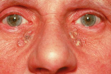 Fig. 34.15, Solar comedones: note the presence of blackheads and multiple yellow cysts.