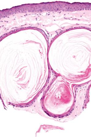 Fig. 34.17, Milia: the cysts are lined by keratinizing stratified squamous epithelium. A granular cell layer is present.