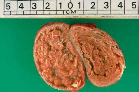 Fig. 34.20, Trichilemmal cyst: this shows the typical macroscopic appearance of cheesy lamellated contents.