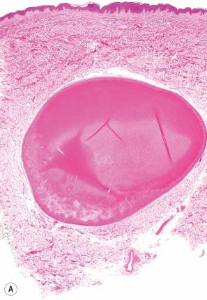 Fig. 34.21, ( A , B ) Trichilemmal cyst: these views show the homogeneous eosinophilic contents. Note the distinct basal cell layer.