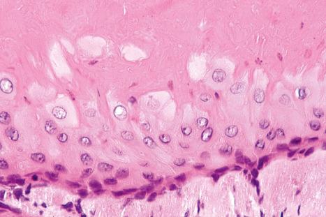 Fig. 34.22, Trichilemmal cyst: the cyst wall is composed of squamous epithelium and a granular cell layer is not present. The most superficial cells are larger, vertically orientated, and have abundant cytoplasm. Keratinization is abrupt.