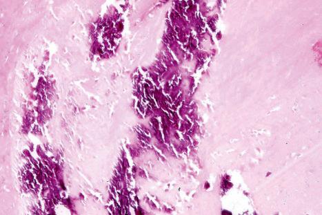 Fig. 34.23, Trichilemmal cyst: basophilic granular calcification is a frequent histologic finding.