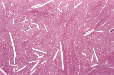 Fig. 34.24, Trichilemmal cyst: the empty spaces (cholesterol clefts) are a common feature of this lesion.