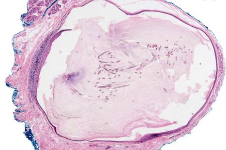 Fig. 34.25, Vellus hair cyst: this thin-walled cyst is present in the mid-dermis.