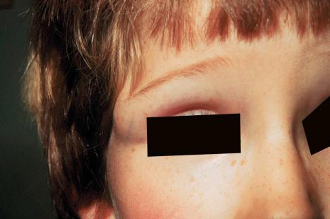 Fig. 34.27, Dermoid cyst: note the swelling adjacent to the upper eyelid – the external angular dermoid cyst.