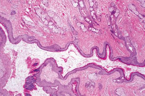 Fig. 34.28, Dermoid cyst: the cyst is lined by stratified squamous epithelium. Note the numerous sebaceous glands.